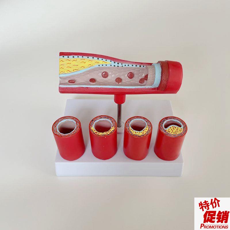 动脉血管阻塞模型粥样变化栓塞狭B窄中老年人血管心脏冠状动脉脂