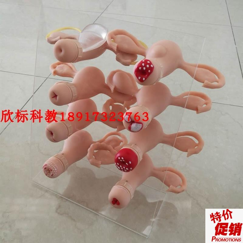 高级子宫宫颈i病变模型(8件)病理子宫对比教具模型