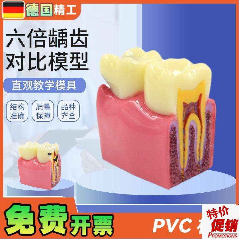 德国】六倍龋齿对比模型口腔牙齿模型口腔教R学蛀牙切面模型牙