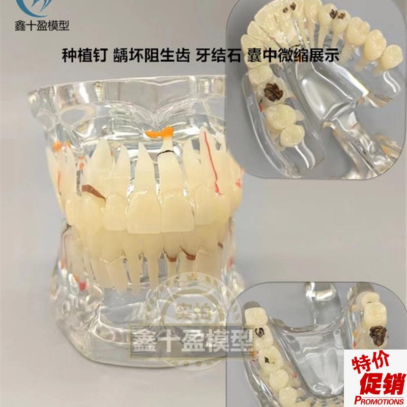 牙科牙齿模型2倍透明牙体综合病理模型口腔P科病理模型医患模型