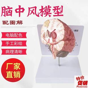 人体脑部疾病模型脑m瘀血管大脑解剖中风脑梗神经外科神经内科模