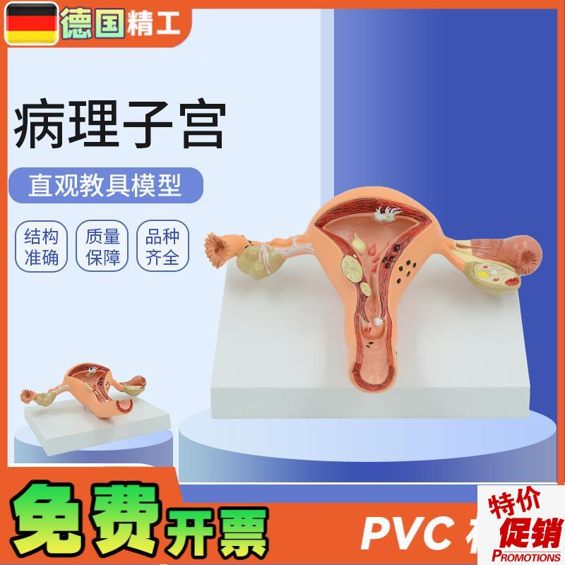 德国人体模型女性生殖子宫阴道卵巢子宫教学O模具病理变化科普培