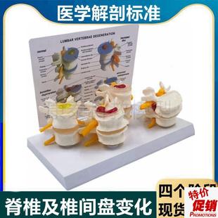 腰椎模型椎间盘受压突出演示老年人脊椎劳损病理比较椎Z骨正骨推