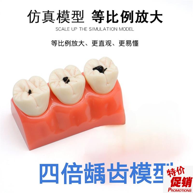 牙科医患沟通病理牙模p型窝沟封闭种植龋齿根管龋齿病理分解模型