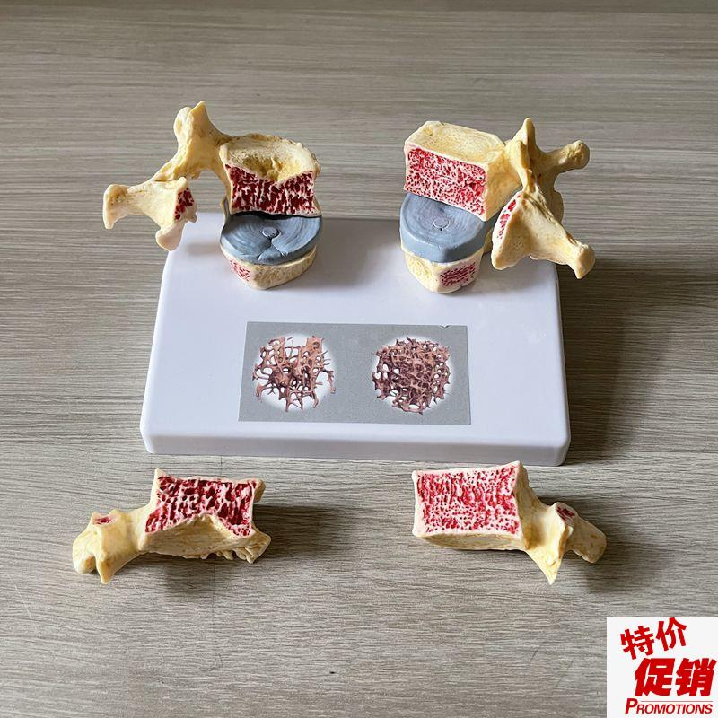 脊椎骨质疏松模型老年人骨骼仿真股骨头密度腰椎变形W劳损医患礼