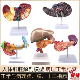 人体肝脏模型肝解剖模型肝胆胰脾十二指肠病M变肝胆胰胆囊消化内