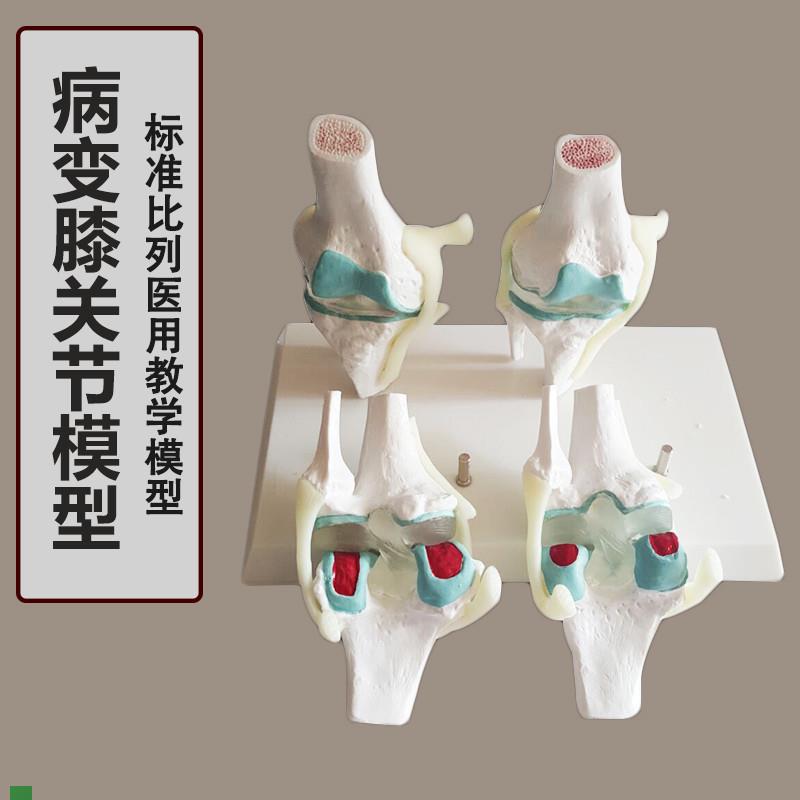 人体病理膝关f节模型 病变 膝关节退行性膝关节/病 关节镜手术