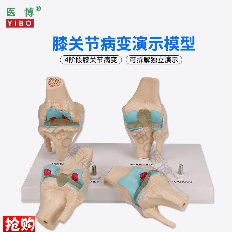 医博BIX-A3571膝关节病变模型人体骨骼病变模型人P体膝关节4阶段