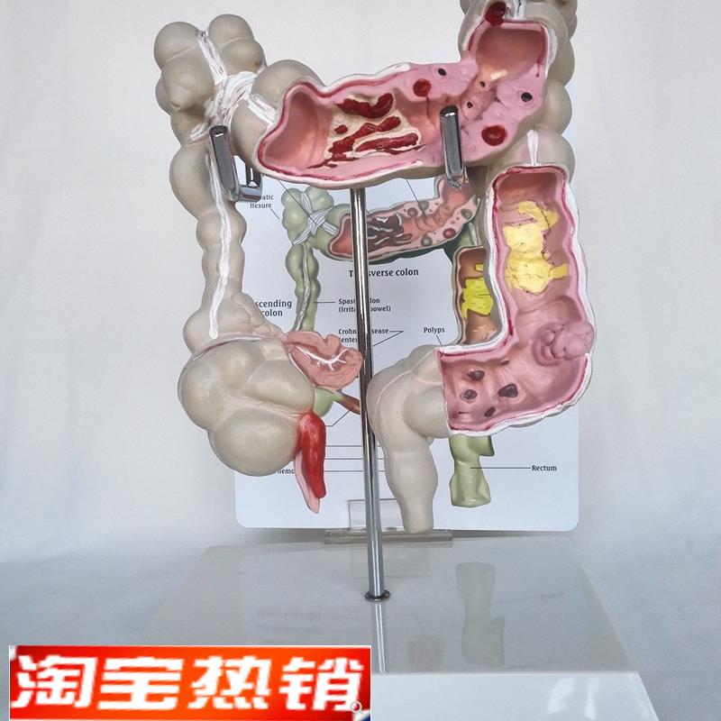 包邮人体结肠直肠病s变模型肠器官医用教学讲解病理展示