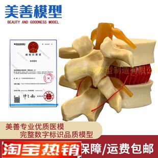 脊柱模型脊椎骨头腰椎r间盘模具椎体模型突出受压病理骨质教具