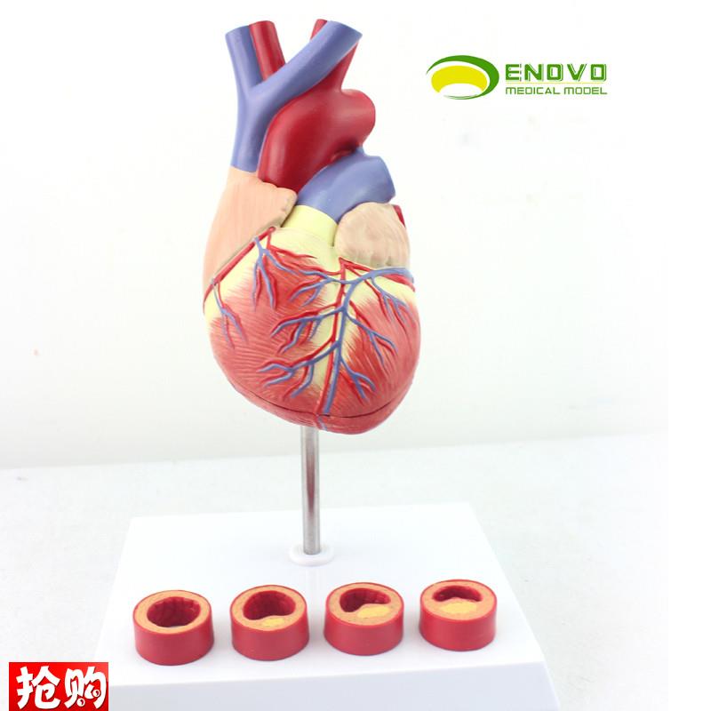 ENOVO颐诺1:1医学人体心脏模型E冠状动脉血栓心内科教学动脉粥样