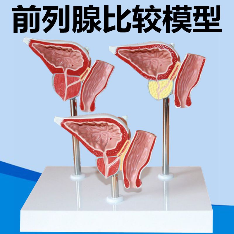 前列腺模型健康病理比p较中老年人前列腺变化医患教具男生殖器解