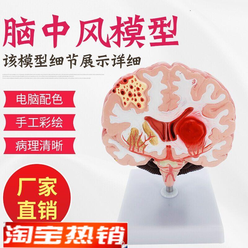 人体脑解剖脑病理疾s病脑病理构造脑(血管)病变脑模型