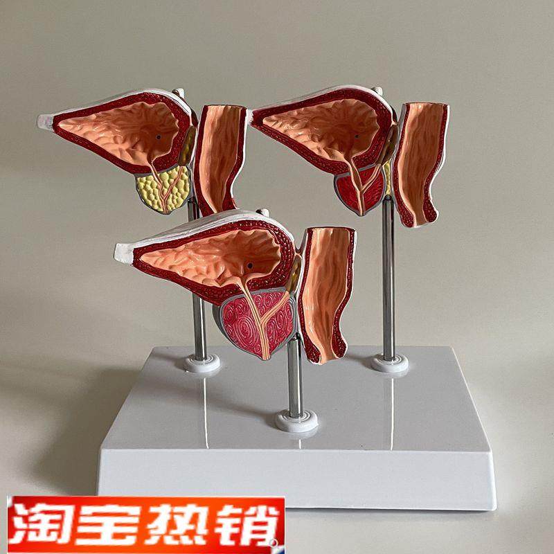 前列腺模型肥囊膀胱尿道狭窄男科医患医药促销Q中老人生殖腺体跨