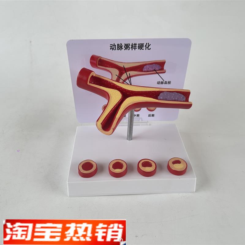 人体血管病理粥样动脉/硬化模型病变血栓/血管/T病演示心解剖教具