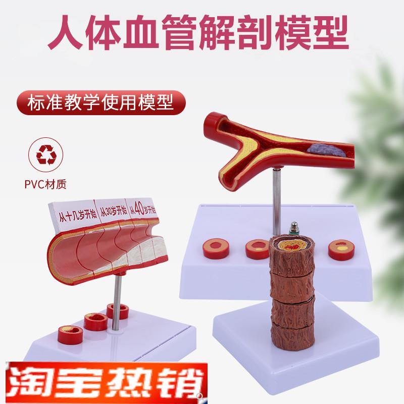 人体血管模型粥样动脉/硬化模型病变血栓K/血管/病演示血管模型