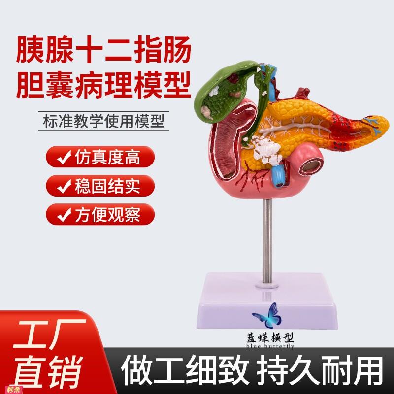 教学彷真人体胰腺十二指肠胆囊病理模型胆结石外科消化系统教具