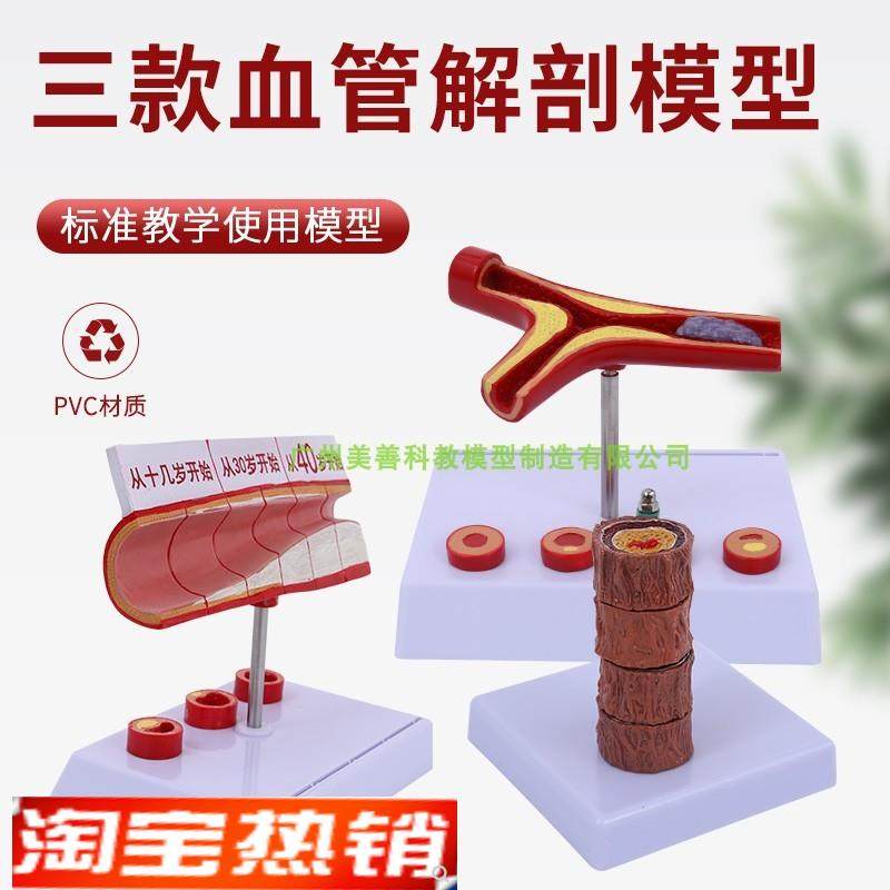 血管/堵塞动支脉粥样o/硬化心血管动脉/硬化模型血管病理模型血栓