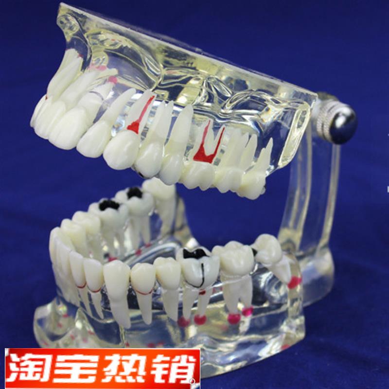 颐诺正品口腔齿科牙科成人口腔病理模型Q口腔牙科牙齿模型