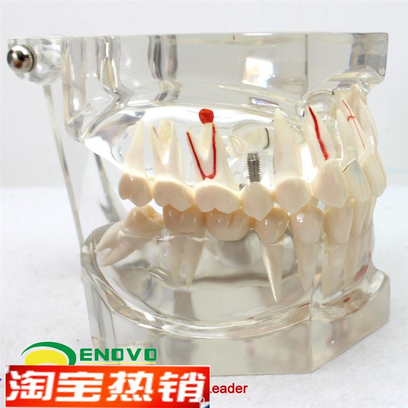 颐诺正品牙d齿模型2倍透明牙体病理模型口腔科病理模型医患模型