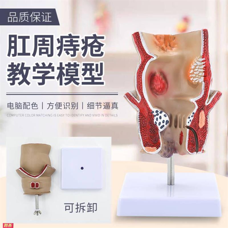教学彷真人体直肠和肛门肛肠疾病痔肛娄溃疡性结肠病理痔疮模型