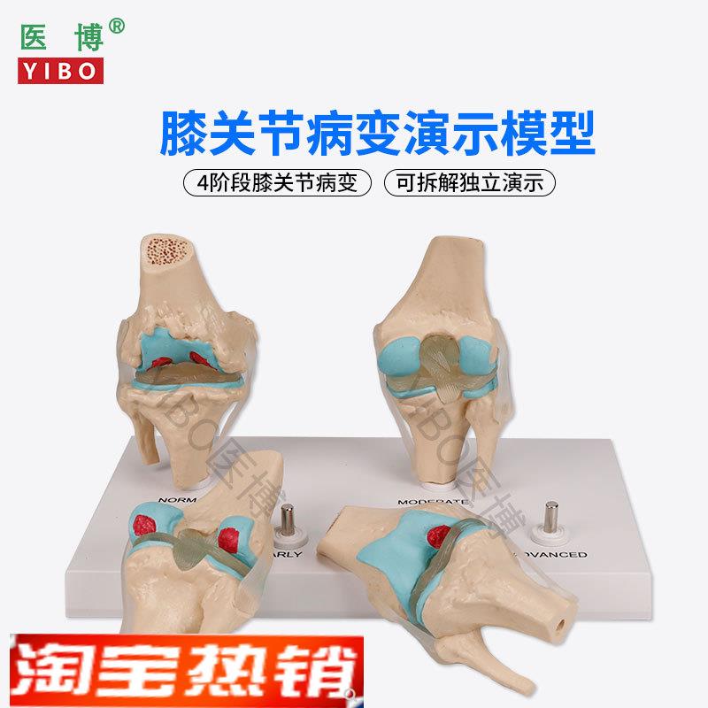 医博BIX-A3571膝关节病变模型人体骨骼病变模型人体Q膝关节4阶段