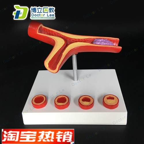 血管堵4塞血液浓度脂肪病理血E液血管粥样血管病理解剖模型