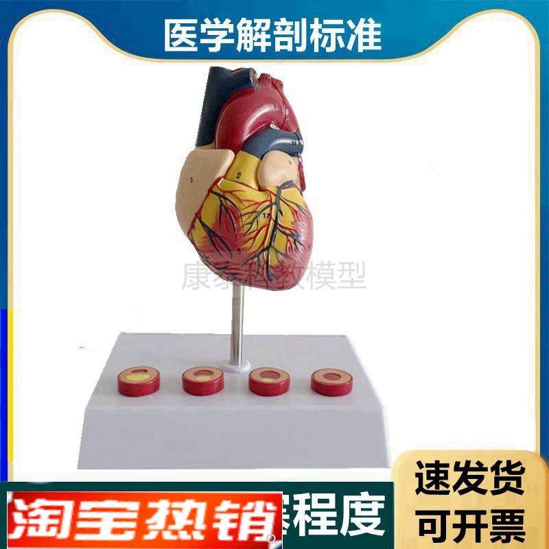 心血管模型冠f状动脉粥样阻塞硬化程度狭窄脂肪斑块内膜栓子医患