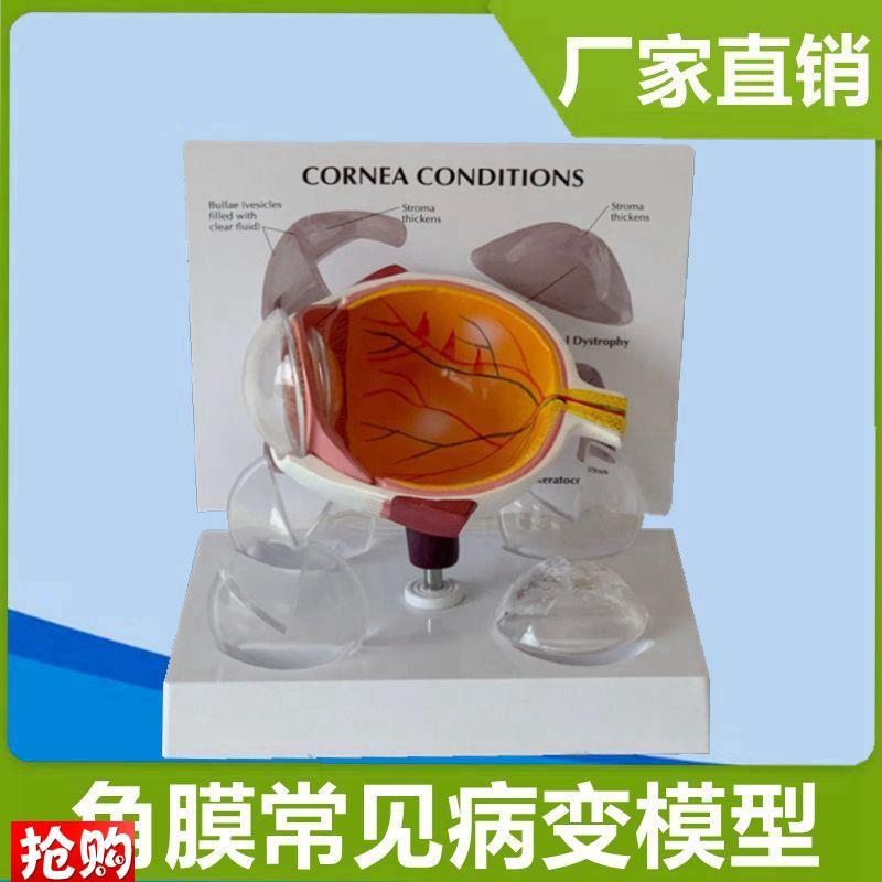 角膜模型可拆卸h人体眼球结构青光眼白内障眼科临床教学医患沟通