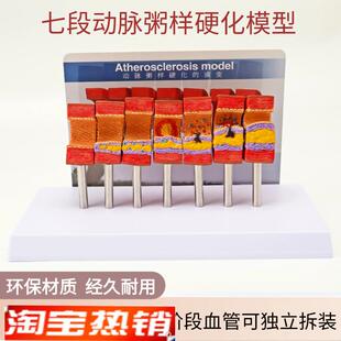 动脉粥样硬化模型血管血栓t栓塞模型动脉血管人体医用医学教学模