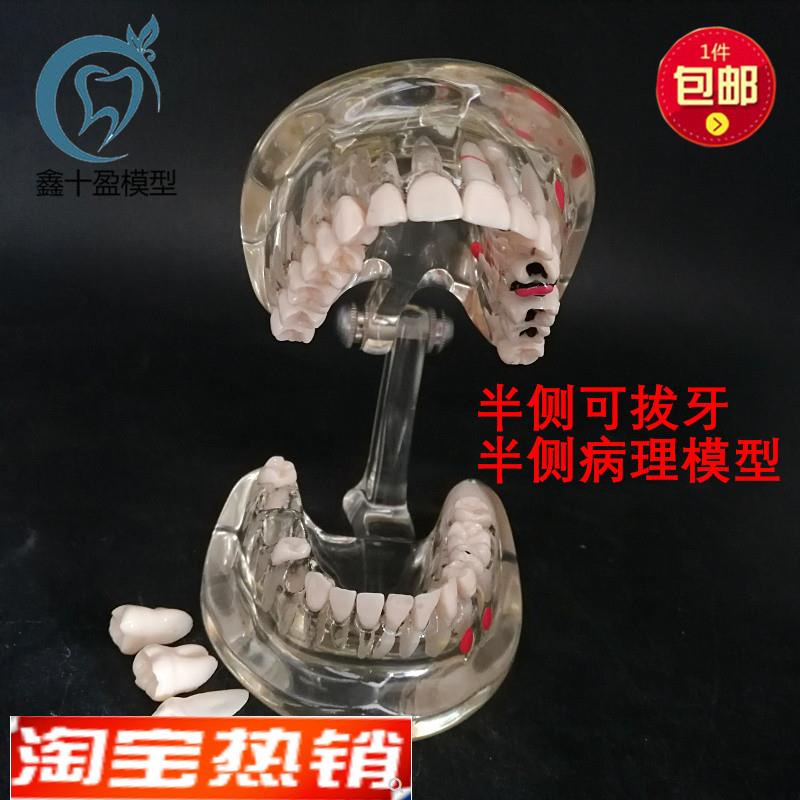 牙科牙齿模型成i人病理半侧可拔牙模型医患沟通口腔教学教具C3