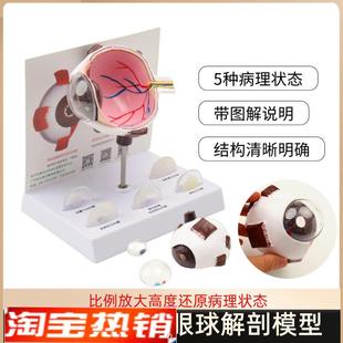 白内障眼球病变模型青光眼眼球结构模型医患教U学解剖展示模型