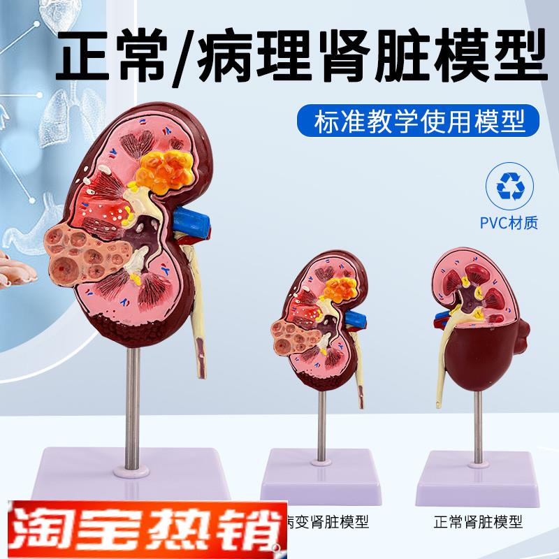 人体肾解剖模型病变肾脏v模型肾脏模型人体内脏器官解剖模型