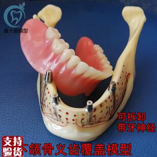 牙科口腔下颌骨展示模型透明下颌骨展F示种植钉义齿修复模型6005
