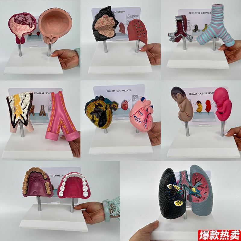 人体正常内脏吸烟病变器官对比心M肺部膀胱血管口腔气管胎医用模