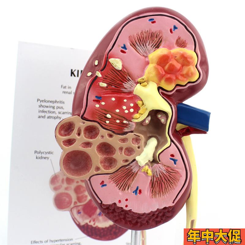 ENOVO颐诺医学人体肾脏解剖模型肾炎肾部模型 Q肾脏病理泌尿外科