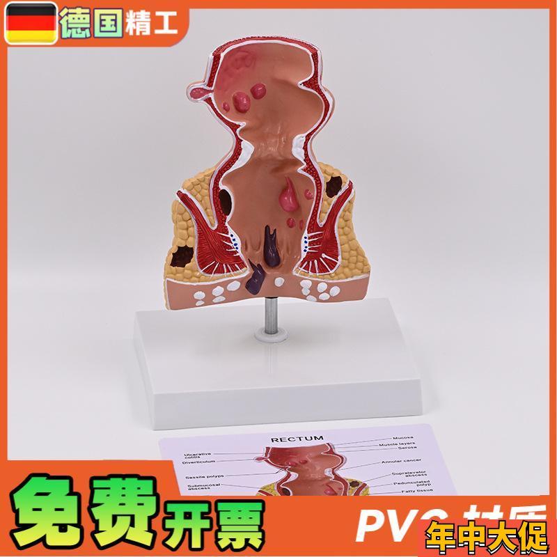 德国】新款大促爆款人体模型肠A直肠解剖病理模型病态疾病教具模