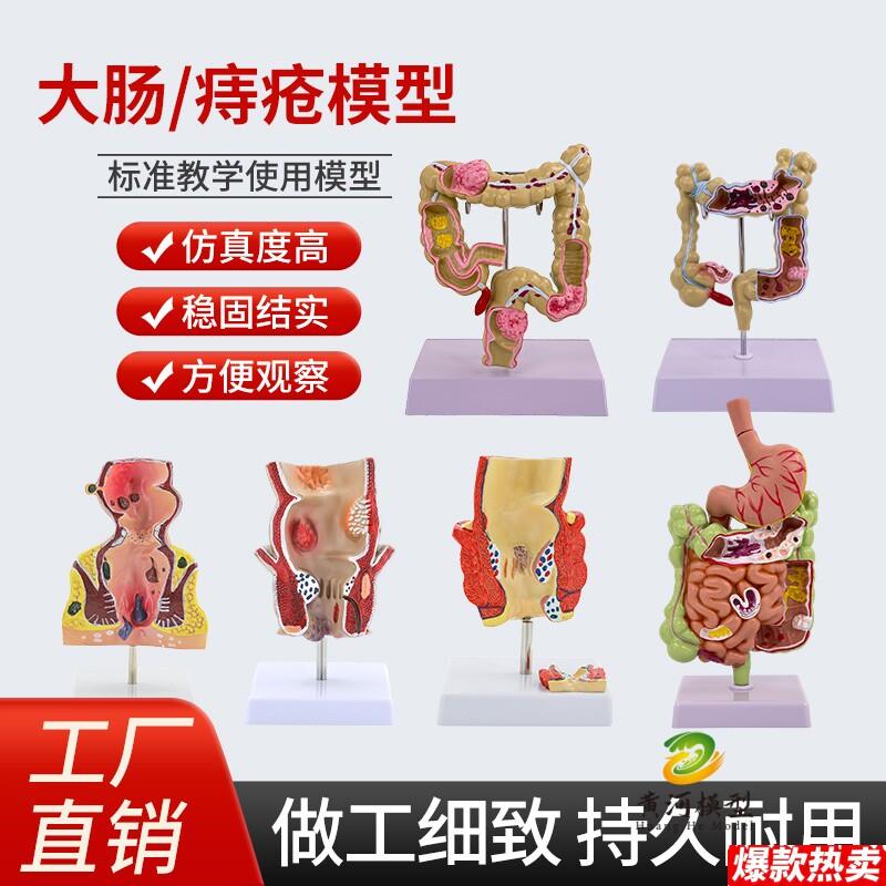 直肠痔疮大肠C结肠病变模型内外直肠痔疮肛门肛肠科模型直肠病理