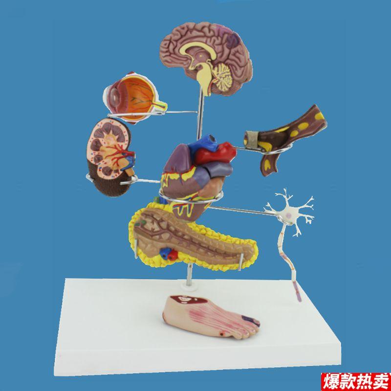 内分泌糖尿模型心血管阻塞g视网膜足脚病理器官受损并发症心脏胰