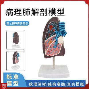 病变肺模型病理肺解剖吸烟者内z脏肺切面呼吸系统人体肺部解剖模