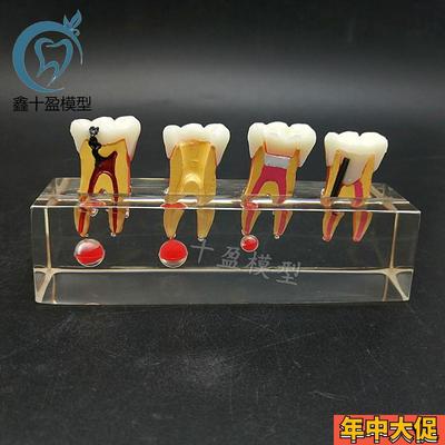 牙科教学模型 乳牙龋病 模型 可拆分牙髓修复 医患沟通U M4018包