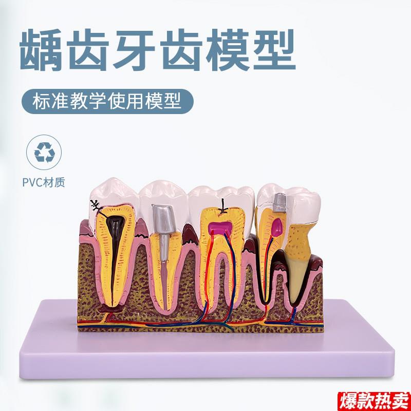 病态牙齿模型虫牙蛀牙牙病牙科疹所教具美n牙牙洞修复牙龈发炎教