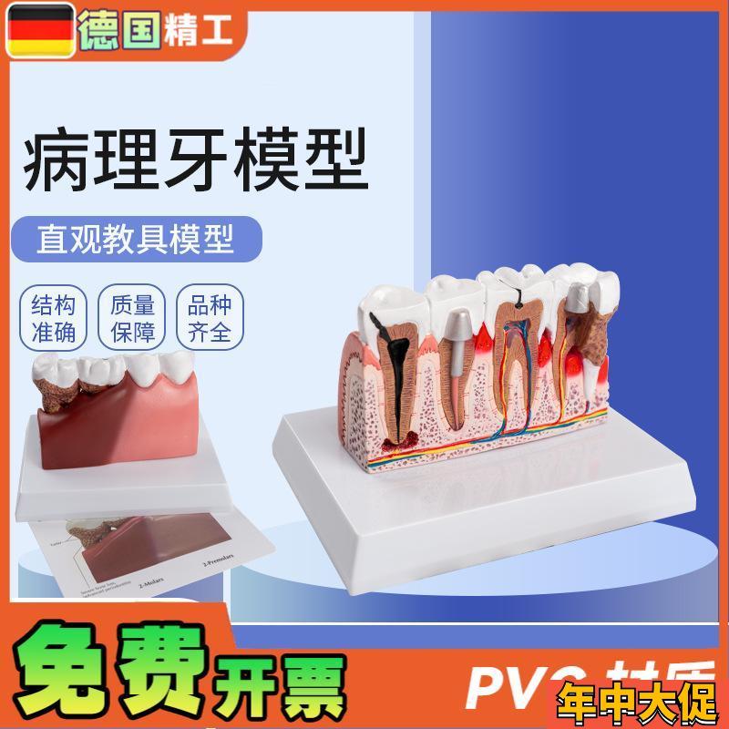 德国】病理牙模型成人病理牙齿模型 口腔模型牙科S教学模型 演示
