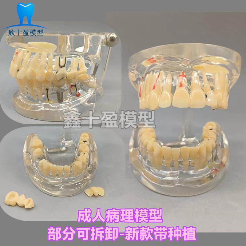 牙科牙齿病理c模型成人全口牙模型牙模医患沟通教育教学种植修复C