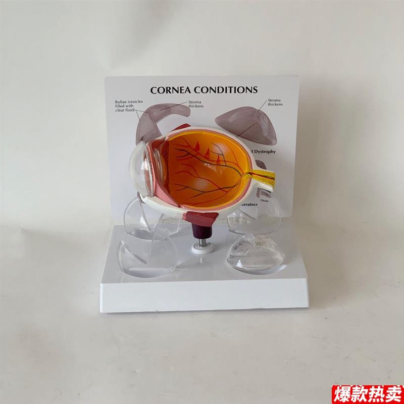 角膜模型视力感觉器官白内障青光眼v视网膜眼底眼科教学医患医药