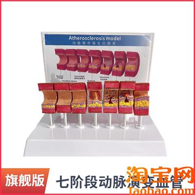 动脉粥样硬化模型血管血栓栓塞模型动脉血K管人体医用医学教学教