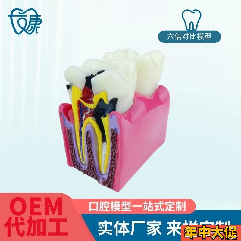 6倍对比模型牙科教学器材6倍龋C齿对比模型口腔模型教学牙齿模型