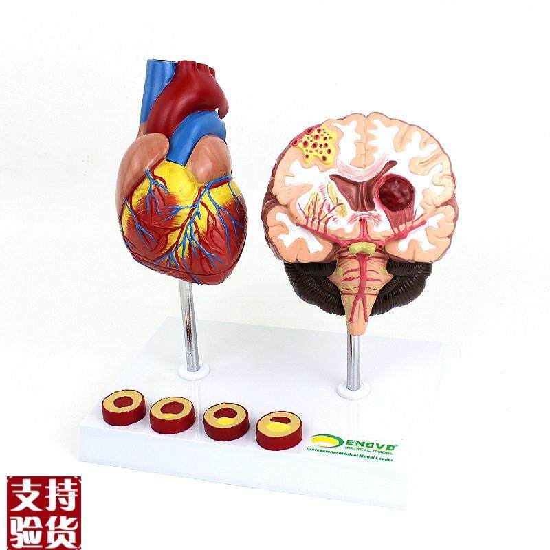 ENOVO颐诺心脑血管疾病展示模型G高血压心脏心血管疾病模型脑,文具电教/文化用品/商务用品,教学标本/模型,淘宝优惠券,粉丝福利购,淘宝优惠卷