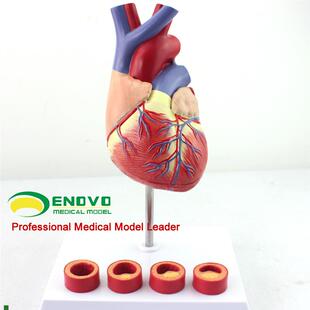 颐诺正品1:1医用人体心脏模型B动脉粥样硬化模型血栓心内科教学