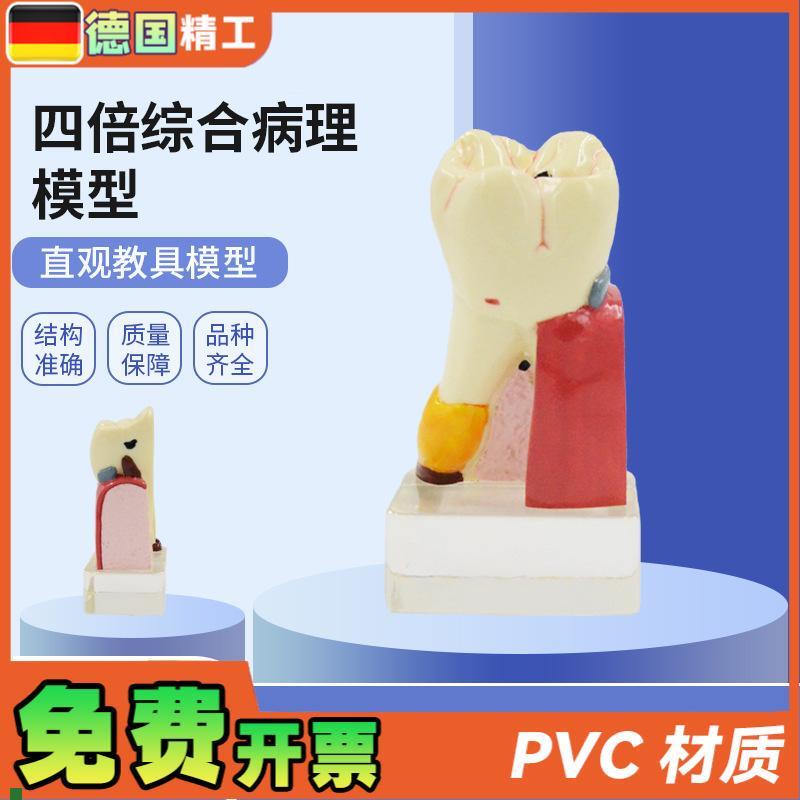 德国PNT-OR11四倍综合病理y蛀牙模型牙齿病变综合病理模型牙齿解